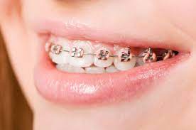 Pierson & Saunders Orthodontics | North Loop reviews